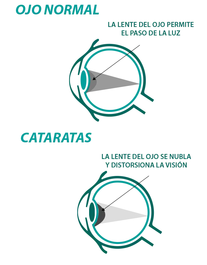 info1-catarata