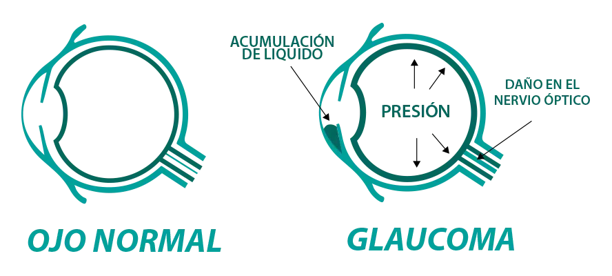 info1-glaucoma