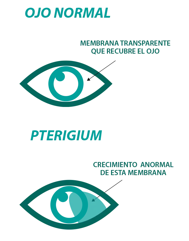 info1-pterigium