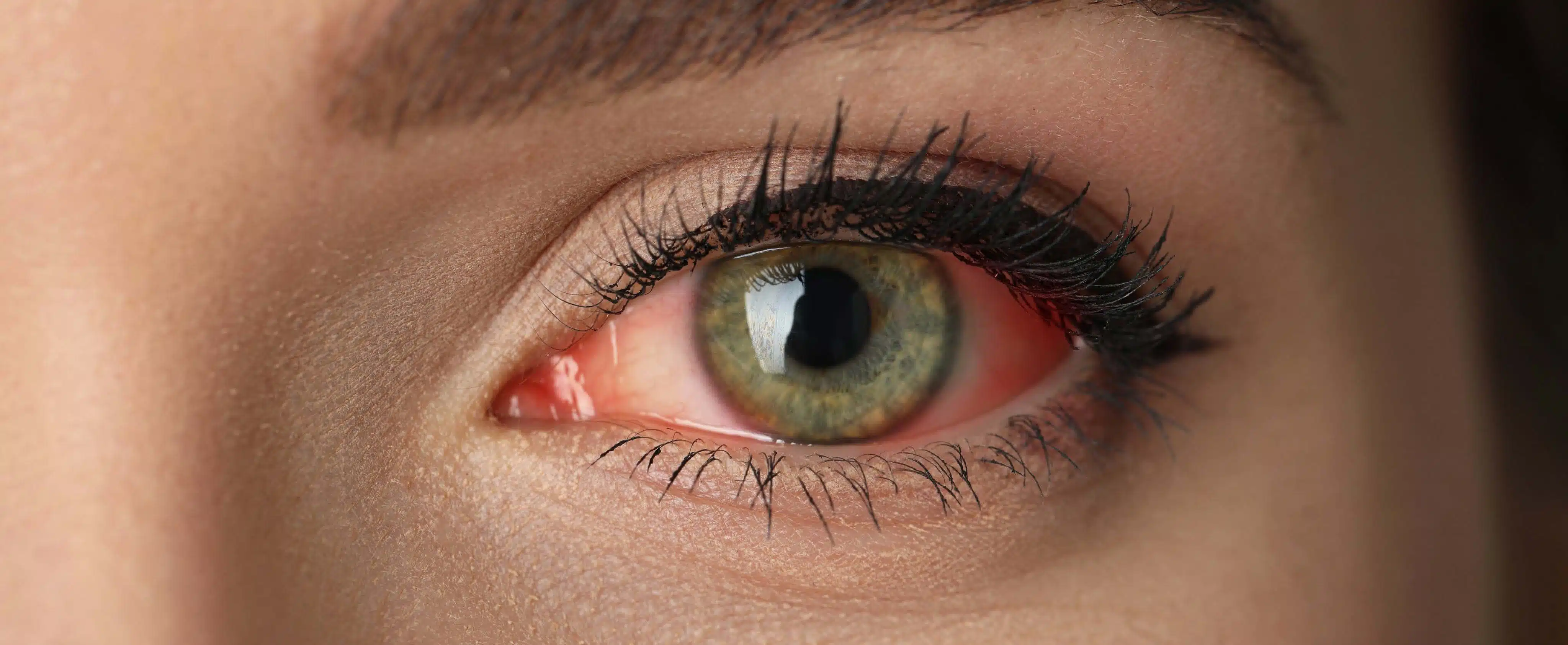 Andes Vision - Articulo_ SPA de ojo Seco2